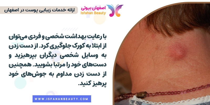 پیشگیری از ابتلا به کورک، پیشگیری از کورک زدن
