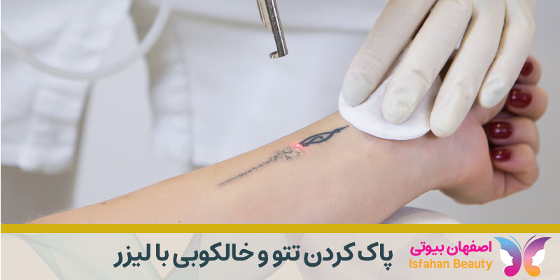 پاک کردن تتو با لیزر
