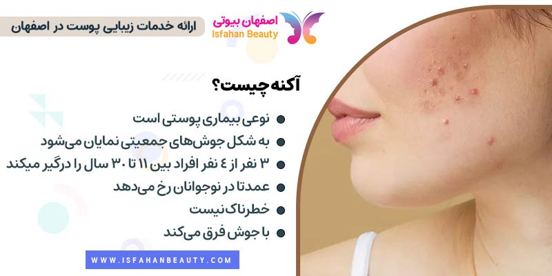 همه چیز در مورد بیماری پوستی آکنه