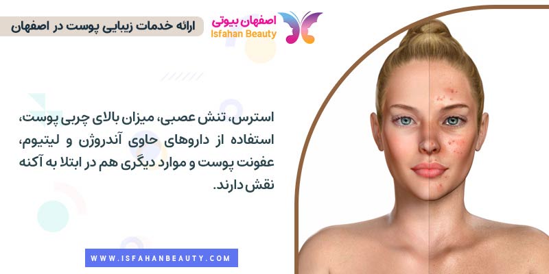 علت ابتلا به بیماری پوستی آکنه