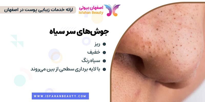 جوش های سر سیاه