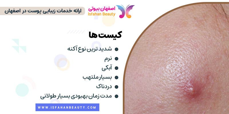 آکنه کیستیک