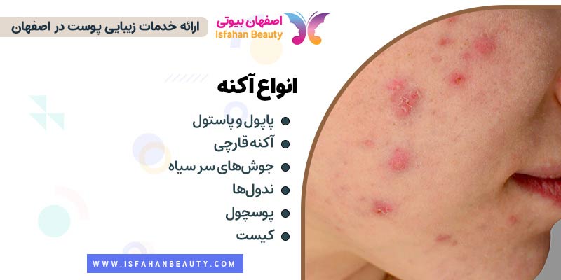 انواع آکنه