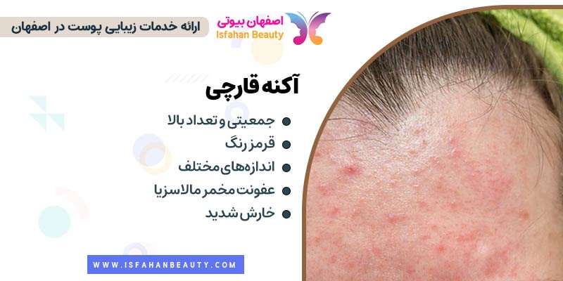 آکنه قارچی