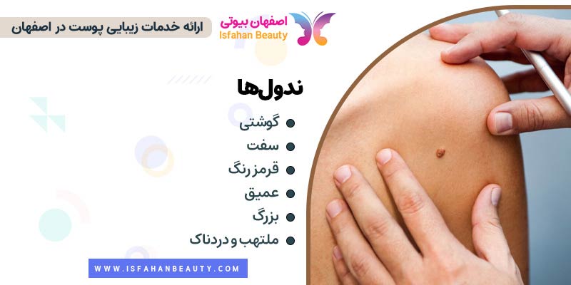 جوش ندول، آکنه ندول