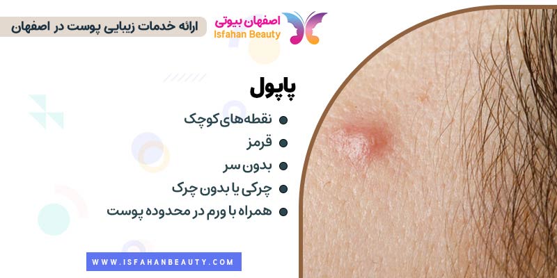 پاپول، جوش پاپول، آکنه پاپول