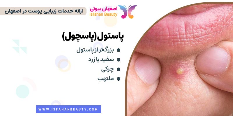 جوش پاستول، جوش پاسچول