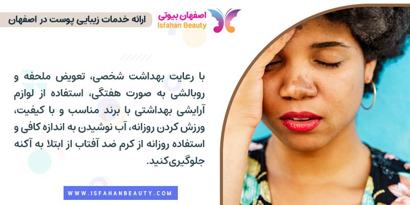 جلوگیری از ابتلا به آکنه، پیشگیری از آکنه