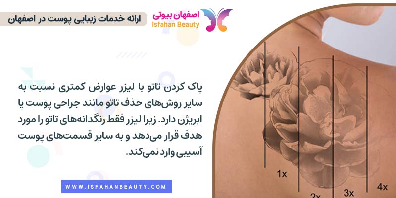 عوارض پاک کردن تتو با لیزر
