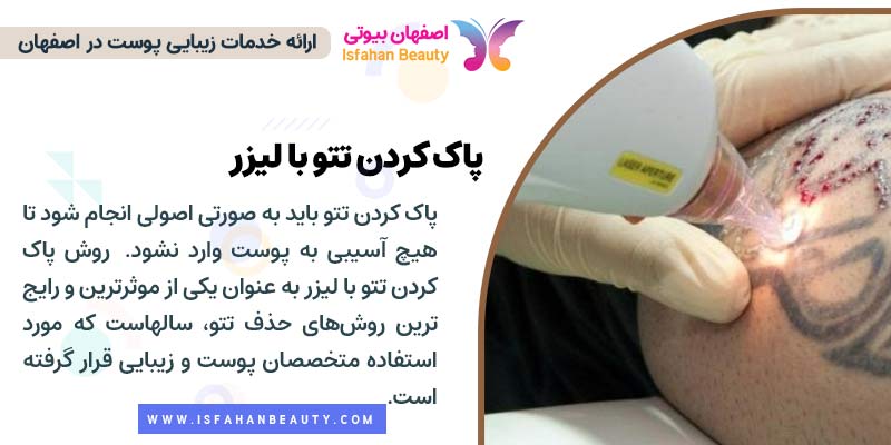 پاک کردن تاتو با لیزر