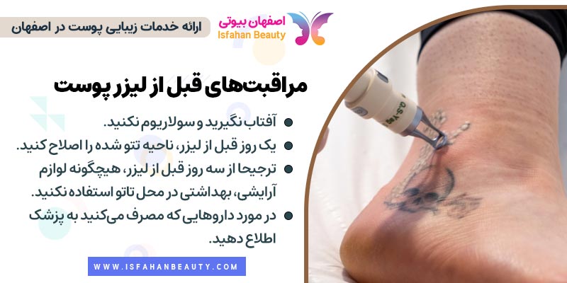 مراقبت های قبل از پاک کردن تتو با لیزر