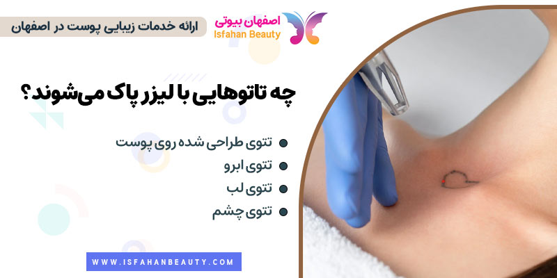 چه تتوهایی با لیزر پاک میشوند