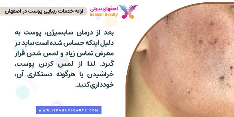 مراقبت های بعد سابسیژن