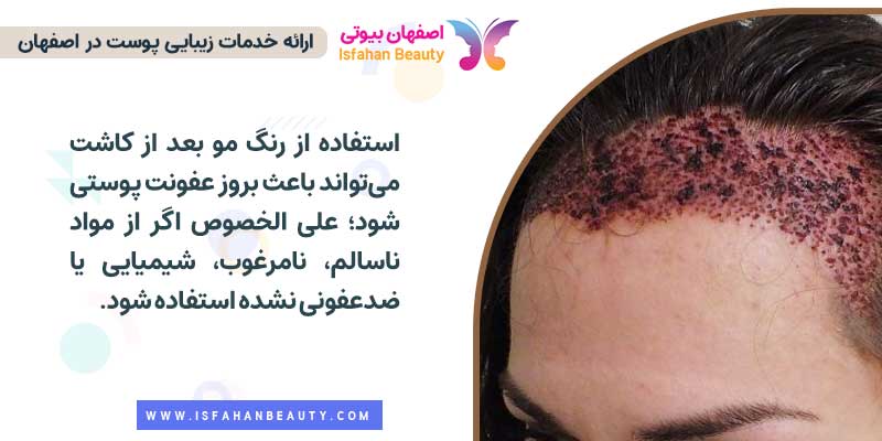 عوارض رنگ کردن بعد از کاشت مو  و ابرو