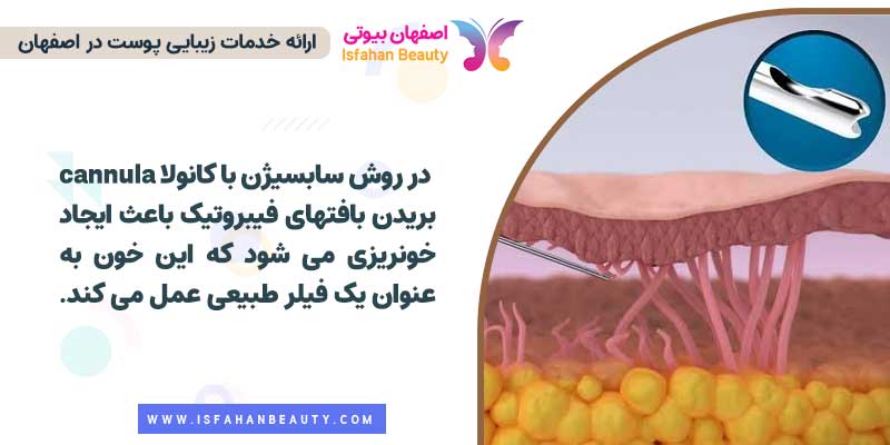 سابسیژن با کانولا cannula