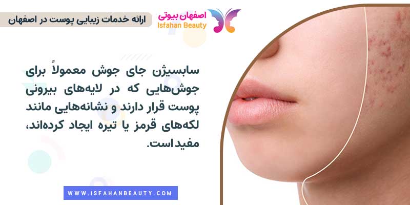 سابسیژن جای جوش