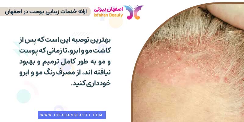 چرا از رنگ بعد از کاشت مو و ابرو نباید استفاده شود؟
