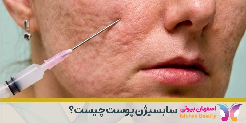 سابسیژن پوست چیست