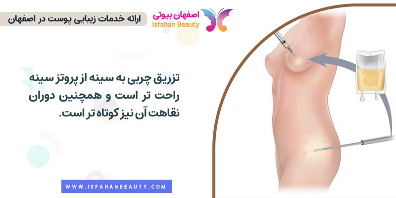 مزایای تزریق چربی در مقابل پروتز سینه