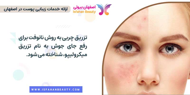 کاربرد تزریق چربی به روش نانوفت
