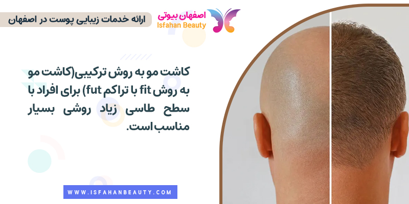 کاشت مو به روش fit با تراکم fut (کاشت مو به روش ترکیبی)