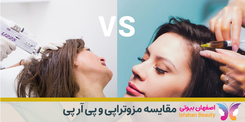 مقایسه مزوتراپی و پی آر پی