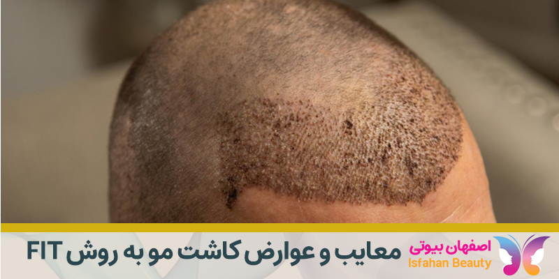 معایب و عوارض کاشت مو به روش FIT