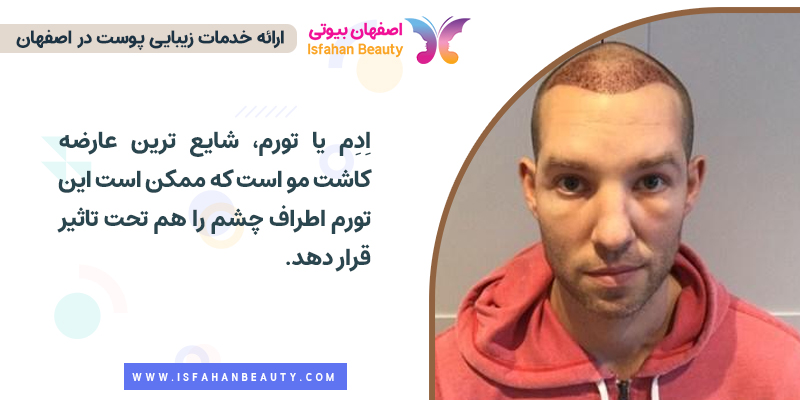 ورم چشم بعد از کاشت مو به روش fit