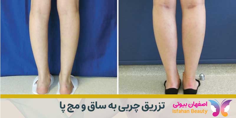 تزریق چربی به ساق و مچ پا