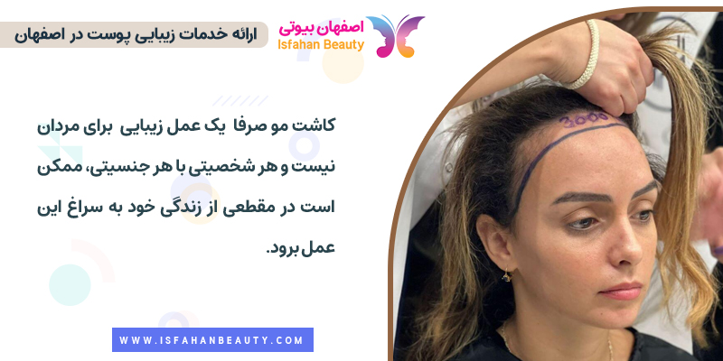 کاشت مو برای زنان