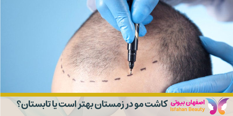 فصل مناسب برای کاشت مو