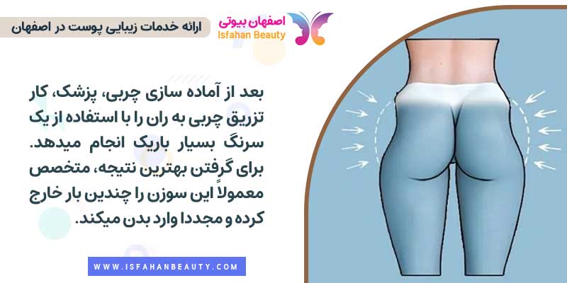 تزریق چربی به بغل ران چگونه انجام می شود؟