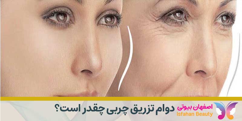دوام تزریق چربی چقدر است؟