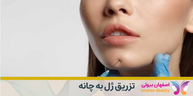تزریق ژل به چانه