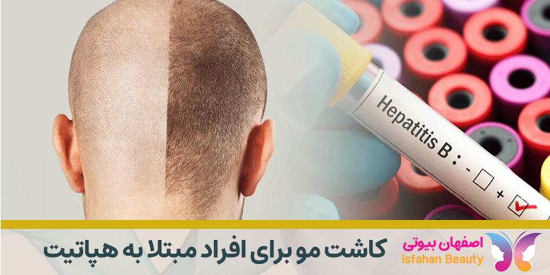 کاشت مو برای افراد مبتلا به هپاتیت