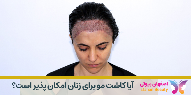 آیا کاشت مو برای زنان امکان پذیر است؟