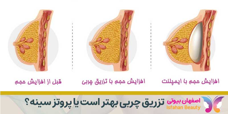تزریق چربی به سینه بهتر است یا پروتز سینه؟