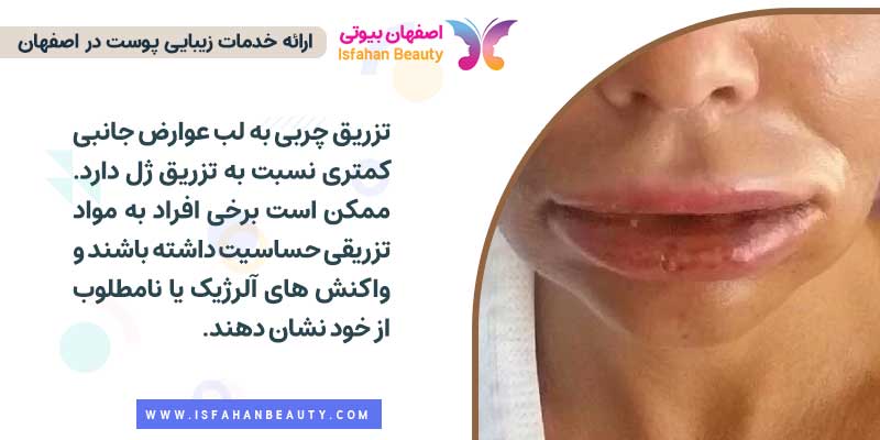 تزریق چربی به لب بهتره یا ژل؟