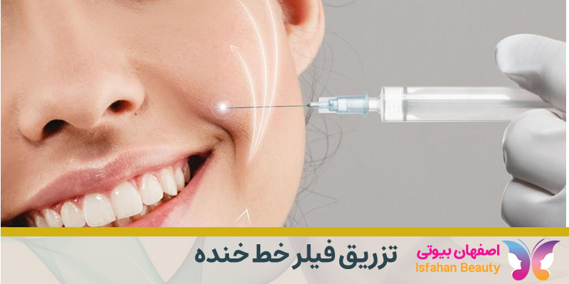 تزریق فیلر خط خنده
