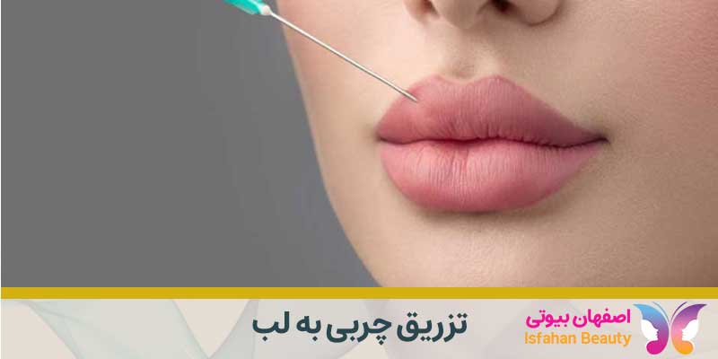 تزریق چربی به لب در اصفهان