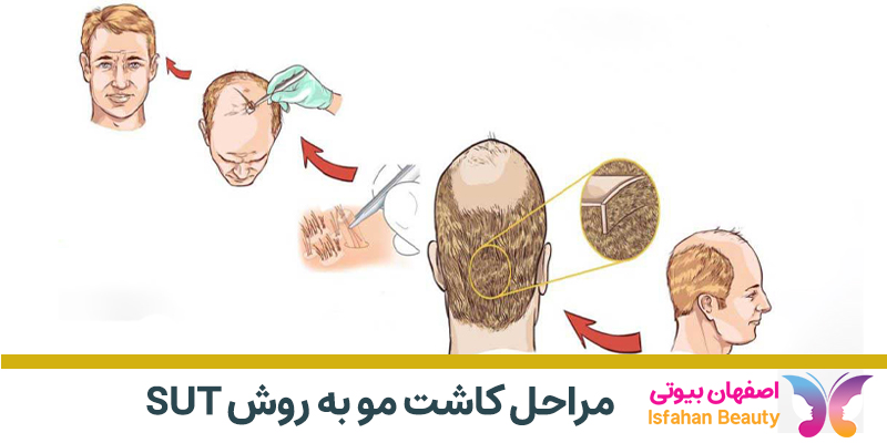 مراحل کاشت مو به روش SUT
