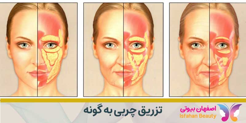 بهترین تزریق چربی گونه در اصفهان