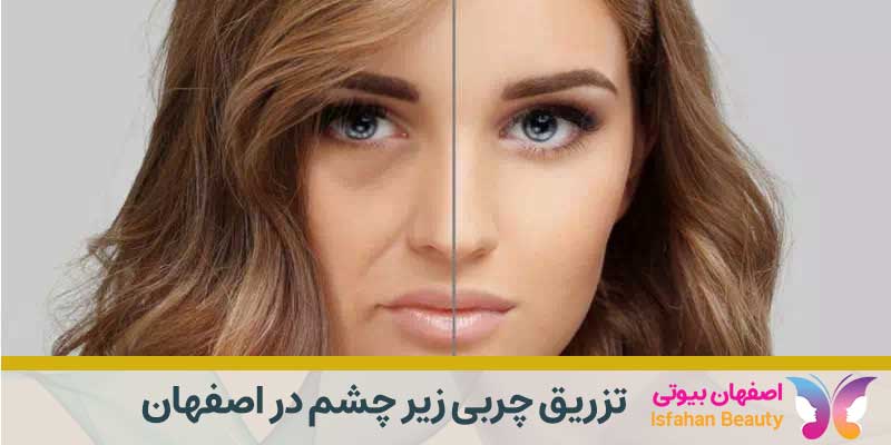 بهترین تزریق چربی زیر چشم در اصفهان
