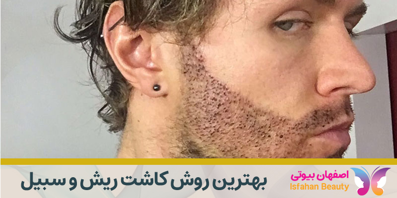 بهترین روش کاشت ریش و سبیل
