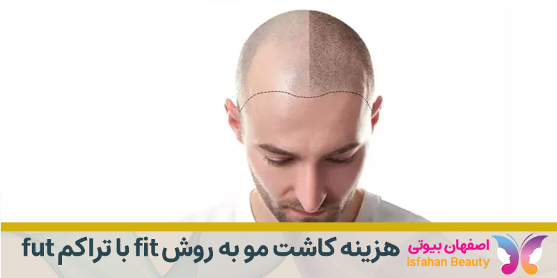 هزینه کاشت مو به روش fit با تراکم fut