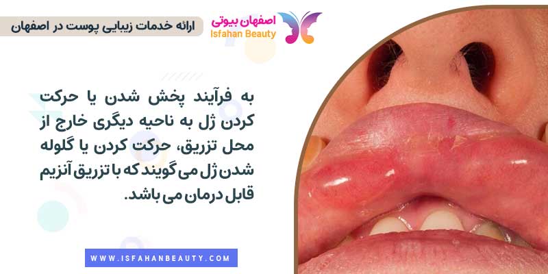 درمان گلوله شدن ژل صورت با تزریق آنزیم