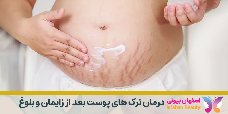 درمان ترک های پوست بعد از زایمان و بلوغ