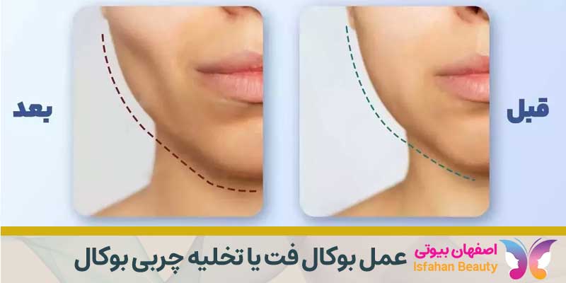 عمل بوکال فت یا تخلیه چربی بوکال چیست؟