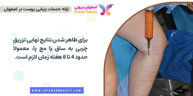 نتایج نهایی تزریق چربی به ساق پا چه زمانی ظاهر می شود؟
