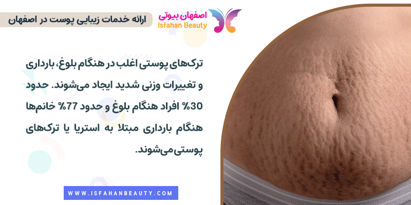 علت ایجاد ترک های پوست بعد از زایمان و بلوغ